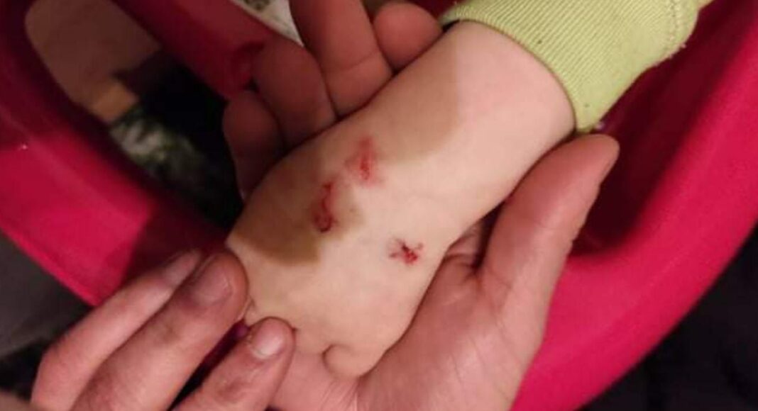 Kind an Hand verletzt