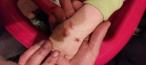 Tatverdächtige ermittelt - kleinkind im kaufland oppenheim verletzt Kind an hand verletzt