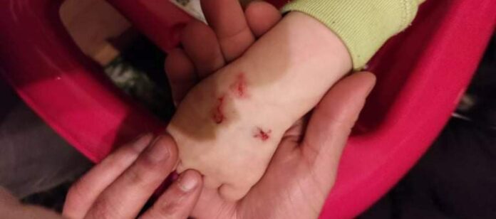 Kind an Hand verletzt Kind an Hand verletzt