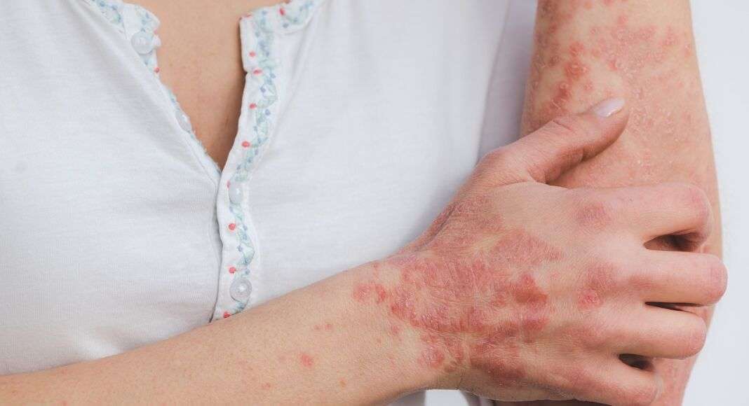 psoriasis gb4f2b2d9c 1280