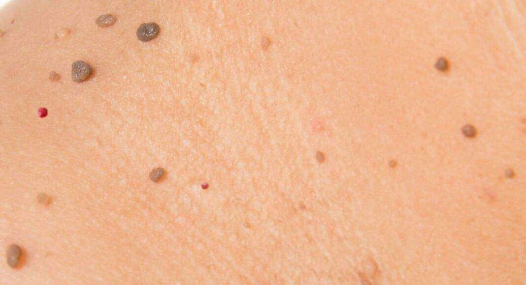 Fibrom Stielwarze Fibrom Stielwarze