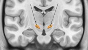 Implantierte THS-Elektroden bei einem Patienten mit Parkinson. © Universitätsmedizin Mainz / Dr. Damian Herz